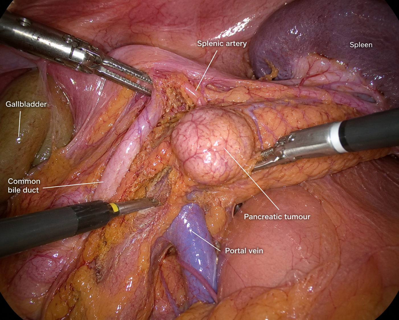 Pancreatic Tumour Surgery